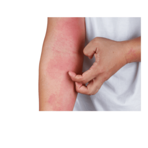 contact dermatitis eczema skin condition treatment private online doctor Gorleston
