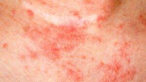 contact dermatitis skin condition treatment private online doctor Gorleston
