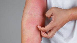 eczema skin condition treatment private online doctor Gorleston