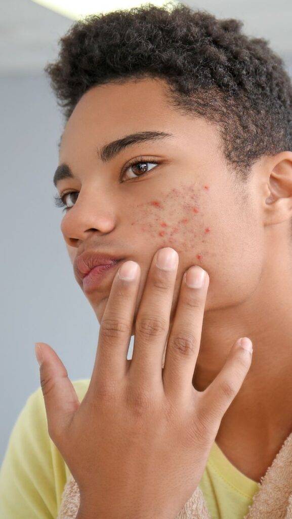 buy acne treatment online