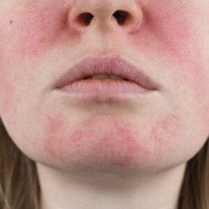 Rosacea online treatment