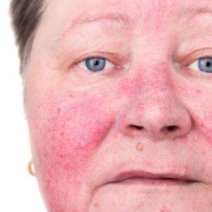 Rosacea treatment online