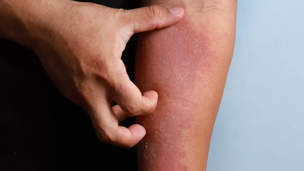 Eczema Is Not Just Dry Skin